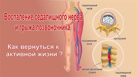 Воспаление седалищного нерва и грыжа позвоночника Как вернуться к