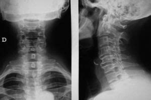 Hiperostosis esquelética idiopática difusa FMC Formación Médica