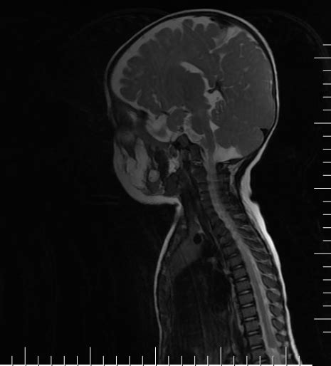 Caudal Regression Syndrome Image