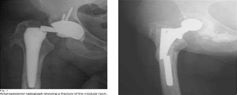 Figure 1 From Surgical Direct Anterior Approach In Total Hip Arthroplasty Tah Anatomy