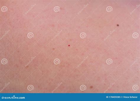 Woman With Birthmarks On Her Skin Stock Image Image Of Close Brown