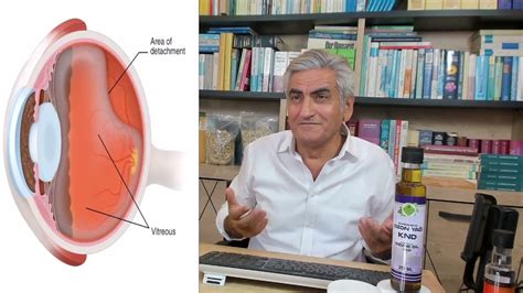 RETİNA Dekolmanı Üveit Retina Çökmesi ve Glokom Göz Tansiyonu Yaban