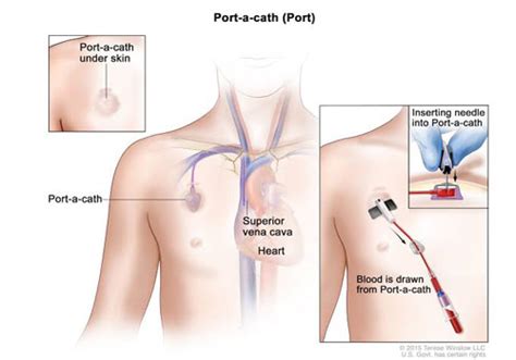 Central Venous Access Devices CVADs Dr Sravan