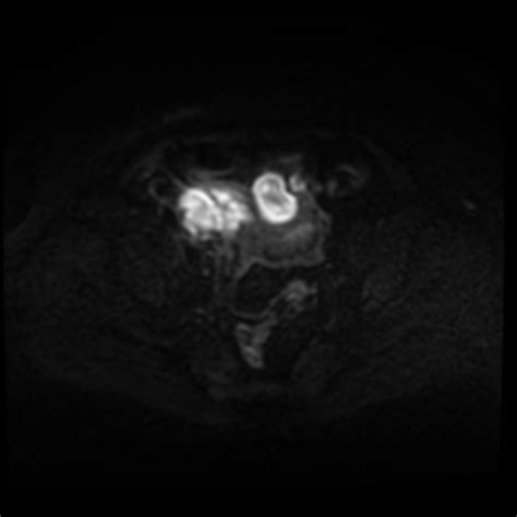 Tubo Ovarian Abscess Following Perforated Appendicitis Image