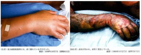 Hisashi Ouchi History S Worst Radiation Victim Kept Alive For 83 Days