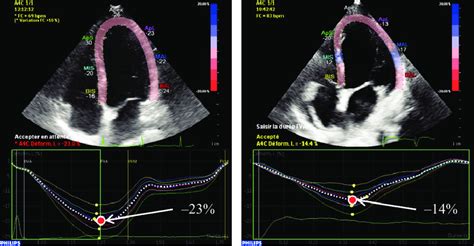 6 Global Longitudinal Strain The Global Longitudinal Strains GLS Are