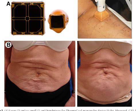 Figure 1 From Noninvasive Radio Frequency For Skin Tightening And Body