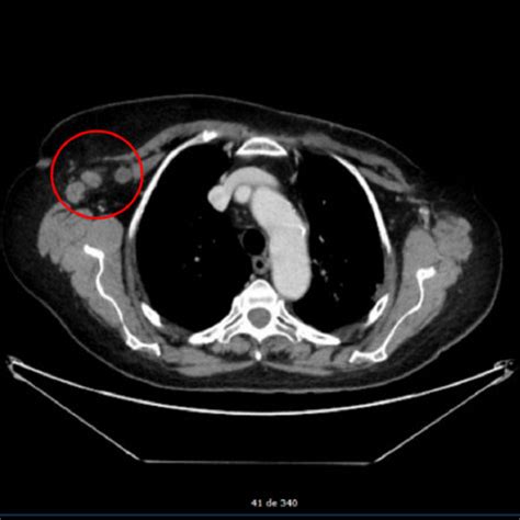 Computer Tomography Scan Showing Right Axillary Lymph Node Enlargement