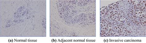 Immunohistochemical Analysis Of A Breast Cancer Tissue Array A Normal