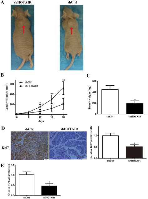 Long Non Coding Rna Hotair Promotes Tumorigenesis And Forecasts A Poor