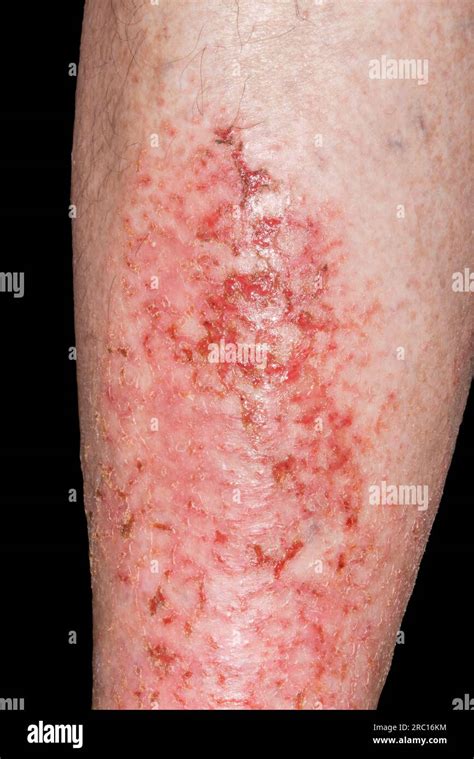 Infected Varicose Eczema Stock Photo Alamy