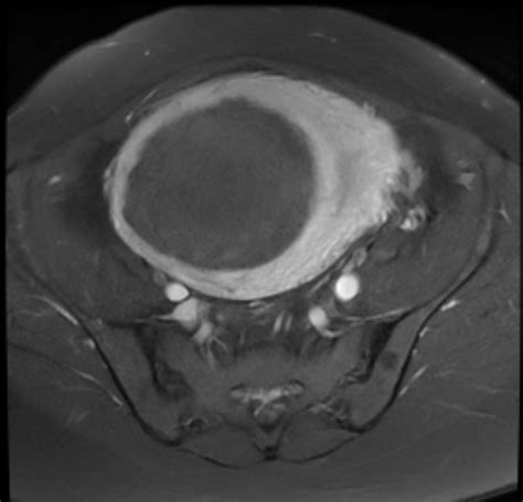 Uterine Leiomyoma With Red Degeneration Image Radiopaedia Org