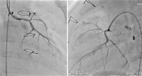 Follow Up Repeat Selective Left Coronary Artery Angiogram With Evidence