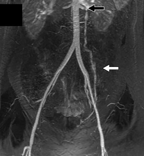 Pelvic Venous Insufficiency Imaging Diagnosis Treatment Approaches