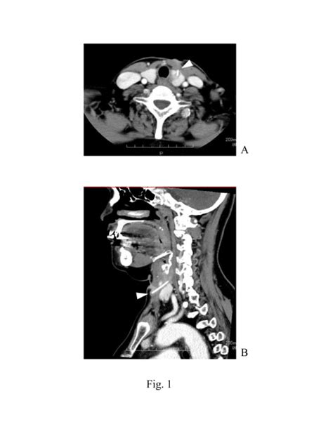 Preoperative Computed Tomography Findings Contrast Enhanced A Axial Download Scientific