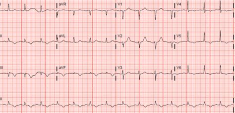 12 Lead EKG Normal Sinus Rhythm