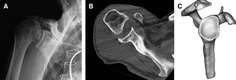 Glenoid Morphology In Reverse Shoulder Arthroplasty Classification And