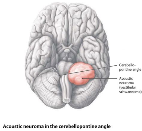 Nsci Vestibulocochlear Nerve Flashcards Quizlet