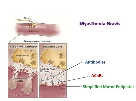 Pathophysiology Of Myasthenia Gravis Schematic Diagram Myast