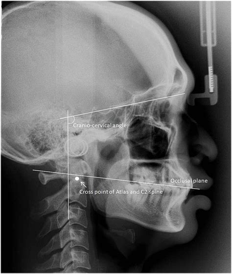 Cephalometric Radiograph Tracing Cephalometric Radiograph Of The