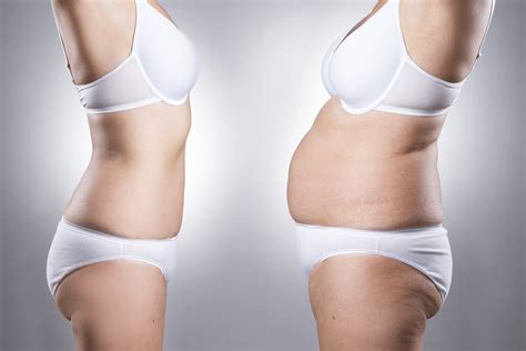 How To Get Insurance To Pay For A Tummy Tuck Livewell