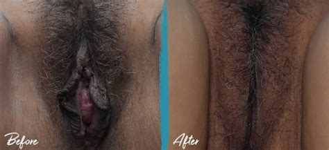 Perineoplasty New Jersey Before And After Photos Alinea Labiaplasty