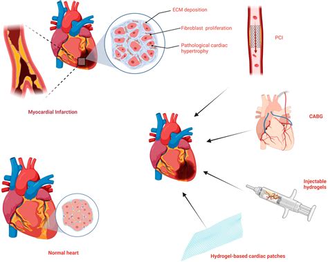 Bioengineering Free Full Text The Role Of Hydrogel In Cardiac