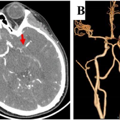 Brain CT Angiography On Admission A Thin Slice Raw Images Of CTA