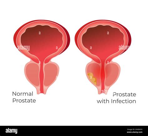 Prostate Gland Anatomy Diagram Stock Vector Images Alamy