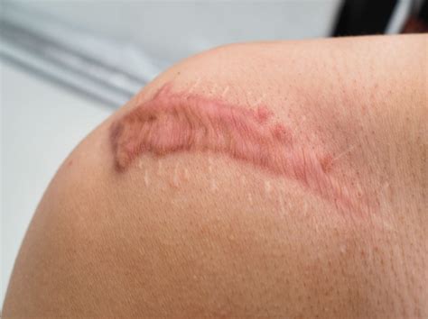 Do Scars Hurt After They Heal At Joshua Pruitt Blog