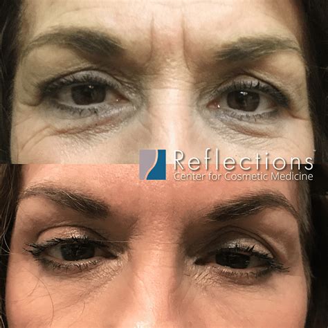 Botox Under The Eyes Reducing Fine Lines And Dark Circles