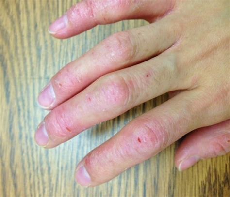 My Experience With Dyshidrotic Eczema Pompholyx 52 Off