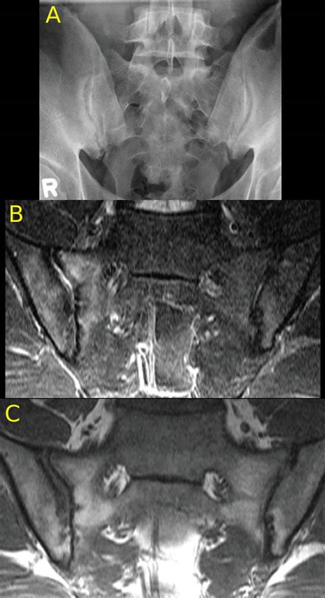 Arthritis Cervical Spine Mri