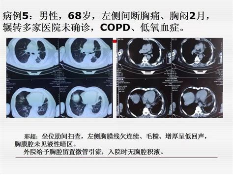 内科胸腔镜技术及应用体会胸膜