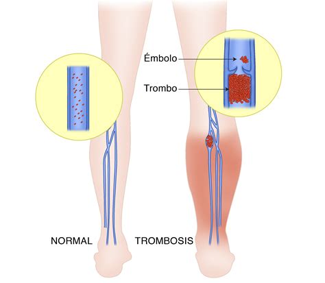 Trombosis Que Es Y Causas Trombosis Venosa Causas Sintomas Y Sexiz Pix