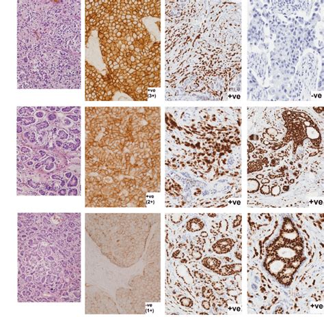 Hematoxylin And Eosin H And E Staining Of Breast Cancer Tissues