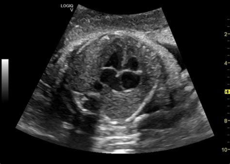 FETAL ECHO Flashcards Quizlet