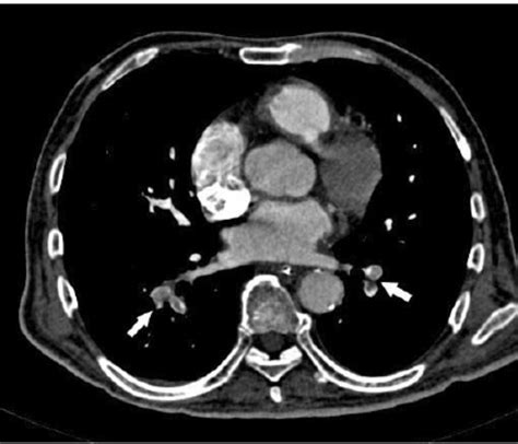 Axial Ct Image Shows Emboli At The Right Middle And Bilateral Lower Download Scientific Diagram