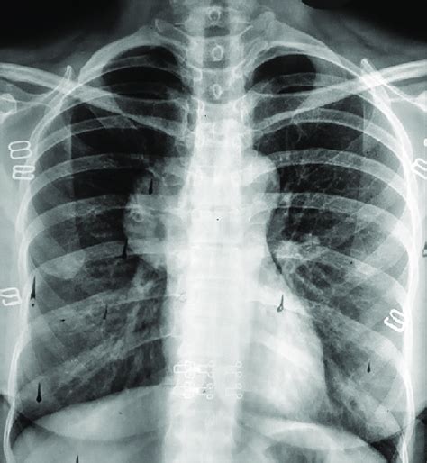 Chest X Ray Showing A Large Opacity Obscuring The Right Hilum Download Scientific Diagram