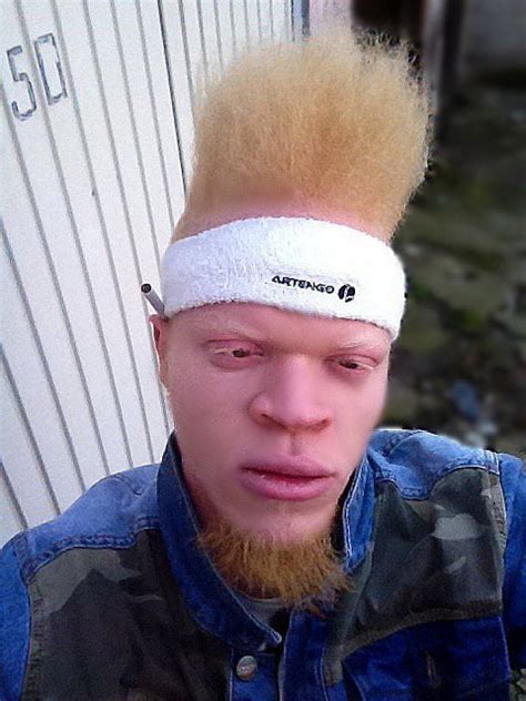 For Those Who Wanted To See A Black Ginger Albino Person This Is