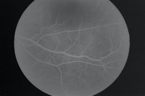 Med Journal 360 Widefield Fluorescein Angiography Beneficial In Evaluation Of X Linked