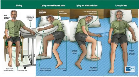 Physiotherapy In Stroke Rehabilitation ‘acute Assessment Phase’