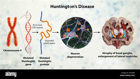 Molecular Genesis Of Huntington S Disease Computer Illustration