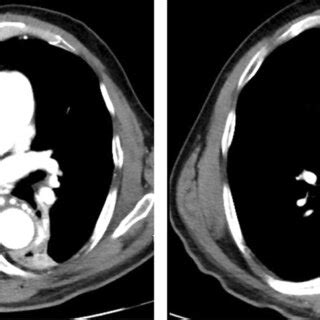 Chest Computed Tomography Plain Scan Left Lower Lobe Bronchus