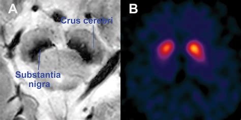 Imaging The Substantia Nigra In Parkinson Disease And Other Parkinsonian Syndromes Radiology