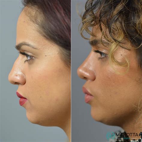 Nose Surgery Before After Patient 03 Dr Marotta