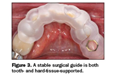 Guided Implant Surgery And Attached Gingiva Dentistry Today