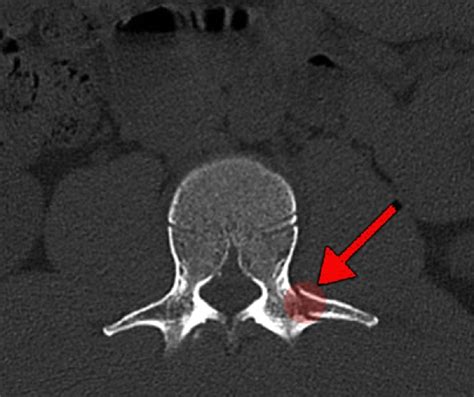 Transverse Process Fracture