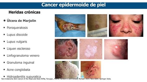 Carcinoma Epidermoide De Piel