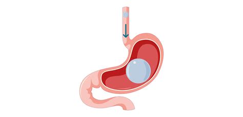 Endoscopic Gastric Balloon Imed Medical